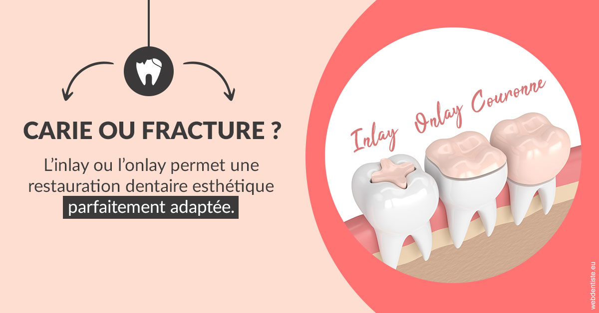 https://dr-pignot-jean-pierre.chirurgiens-dentistes.fr/T2 2023 - Carie ou fracture 2