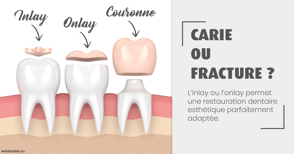https://dr-pignot-jean-pierre.chirurgiens-dentistes.fr/T2 2023 - Carie ou fracture 1