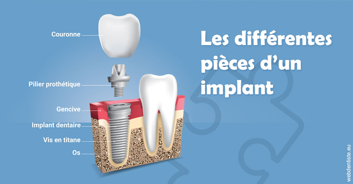 https://dr-pignot-jean-pierre.chirurgiens-dentistes.fr/Les différentes pièces d’un implant 1