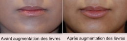 Avant et après l'augmentation des lèvres